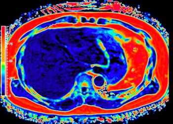Pilvaplėvės karcinomatozė: simptomai, gydymas ir prognozė