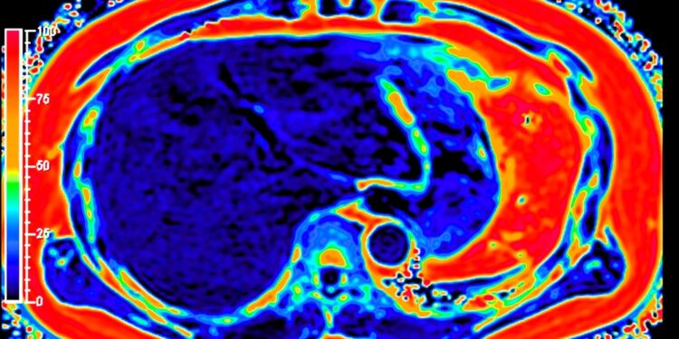 Pilvaplėvės karcinomatozė: simptomai, gydymas ir prognozė