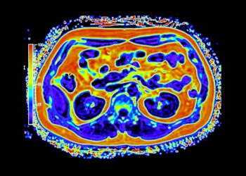 Kas yra metastazės? (IV stadija, metastazavęs arba antrinis vėžys)