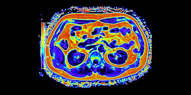 Kas yra metastazės? (IV stadija, metastazavęs arba antrinis vėžys)