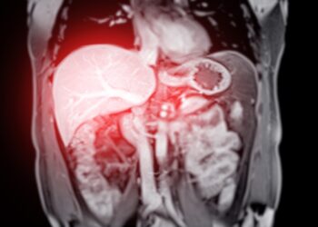 Hepatoblastoma: simptomai, priežastys ir gydymas