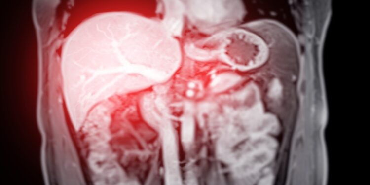 Hepatoblastoma: simptomai, priežastys ir gydymas