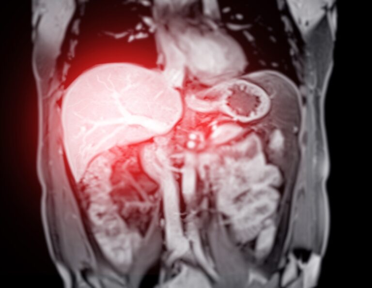 Hepatoblastoma: simptomai, priežastys ir gydymas
