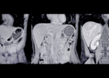 Leiomiosarkoma: simptomai, gydymas ir prognozė