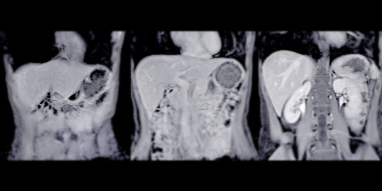 Leiomiosarkoma: simptomai, gydymas ir prognozė
