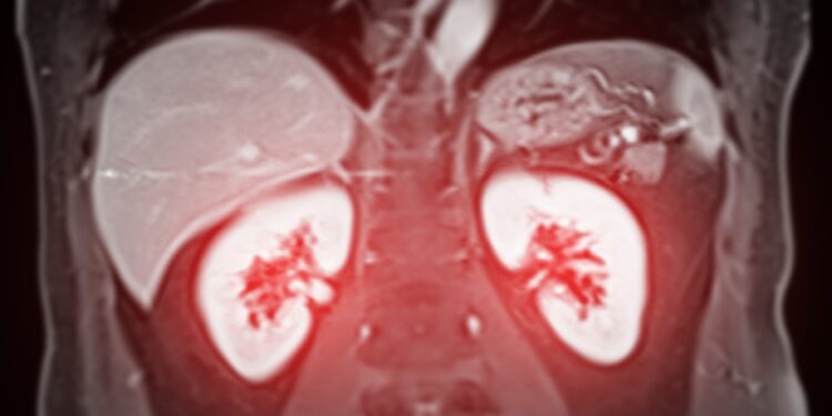 Inkstų cistos: priežastys, simptomai, gydymas ir profilaktika