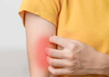 Kiek laiko trunka alerginė reakcija į maistą?