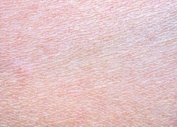 Vulgarinė ichtiozė: priežastys, simptomai, gydymas ir sveikimas