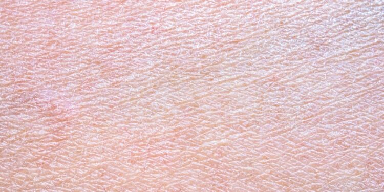 Vulgarinė ichtiozė: priežastys, simptomai, gydymas ir sveikimas