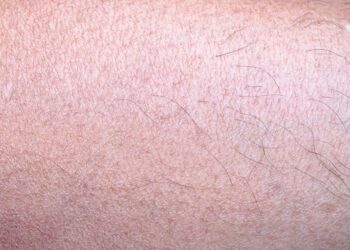 Harlekino ihtiozė: priežastys, simptomai ir gydymas