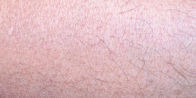 Harlekino ihtiozė: priežastys, simptomai ir gydymas