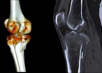 Girnelės lūžis: tipai, simptomai, gydymas ir operacija