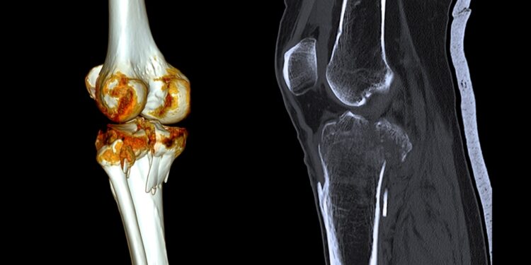 Girnelės lūžis: tipai, simptomai, gydymas ir operacija