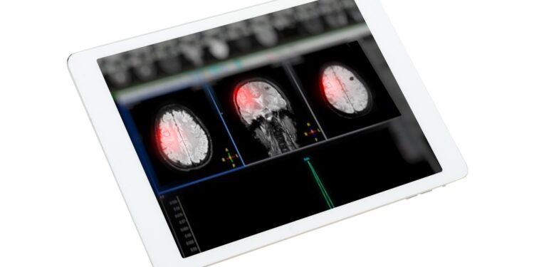 Metabolinė encefalopatija: kas tai, priežastys ir simptomai