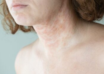 Lichen nitidus: simptomai, diagnostika, gydymas ir prognozė