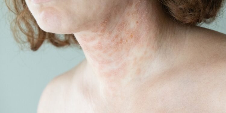 Lichen nitidus: simptomai, diagnostika, gydymas ir prognozė