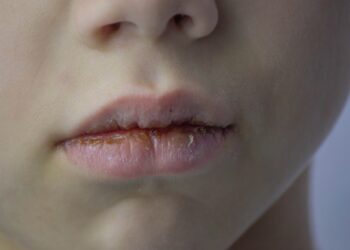 Granulomatinis cheilitas: priežastys, simptomai ir gydymas
