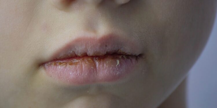 Granulomatinis cheilitas: priežastys, simptomai ir gydymas
