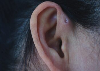 Otorėja: kas tai, priežastys ir gydymas