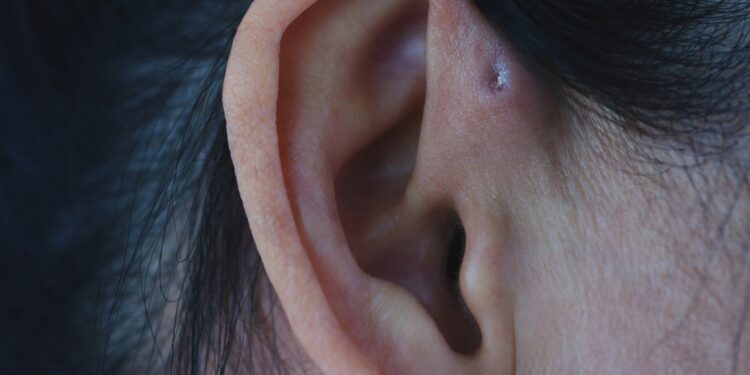 Otorėja: kas tai, priežastys ir gydymas