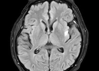 Kleine-Levino sindromas: simptomai, priežastys ir prognozė