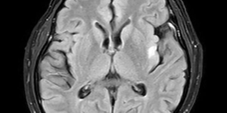 Kleine-Levino sindromas: simptomai, priežastys ir prognozė