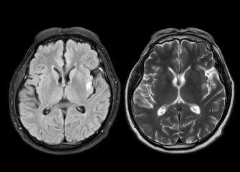 Metachromatinė leukodistrofija: kas tai, priežastys ir simptomai