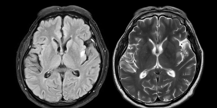 Metachromatinė leukodistrofija: kas tai, priežastys ir simptomai
