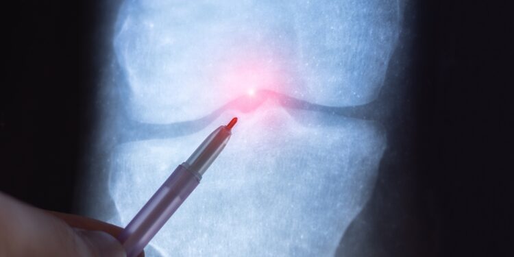 Patologinis lūžis: kas tai, priežastys ir gydymas