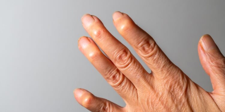 10 patarimų, kaip malšinti skausmą paūmėjus žvynelinės artritui rankų ir kojų pirštuose