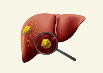Metabolinių sutrikimų sukelta kepenų suriebėjimo liga (MASLD)