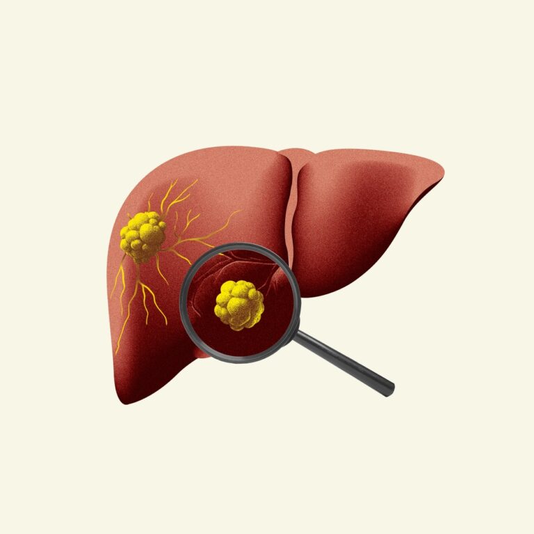 Metabolinių sutrikimų sukelta kepenų suriebėjimo liga (MASLD)