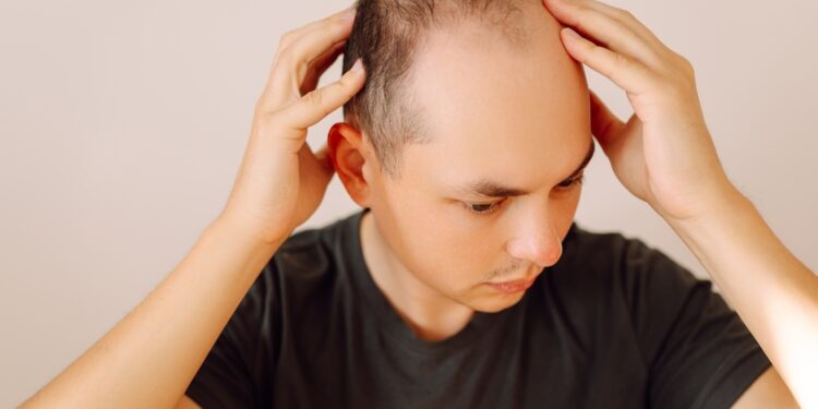 Vyriškojo tipo plikimas (androgeninė alopecija): stadijos ir gydymas