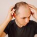 Vyriškojo tipo plikimas (androgeninė alopecija): stadijos ir gydymas