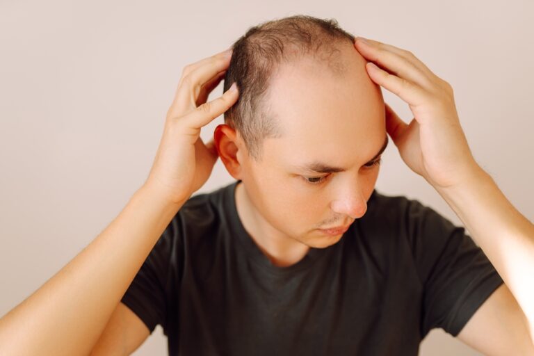 Vyriškojo tipo plikimas (androgeninė alopecija): stadijos ir gydymas