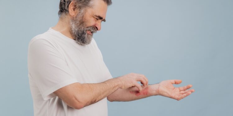 Numulinė egzema ir grybelis (žiedinė dedervinė): priežastys, simptomai, gydymas