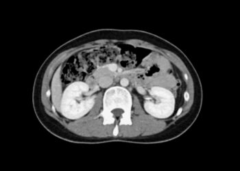 Perikardo cista: priežastys, simptomai ir gydymas