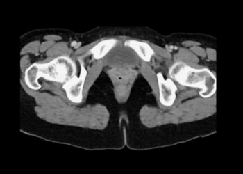 Pendredo sindromas: simptomai, priežastys ir gydymas