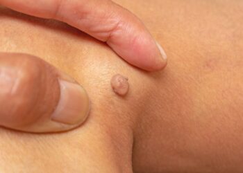 Fibroma: simptomai, priežastys ir gydymas