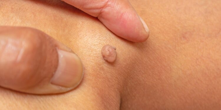 Fibroma: simptomai, priežastys ir gydymas