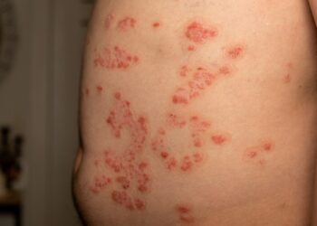 Pempigija foliacija: simptomai, priežastys ir gydymas