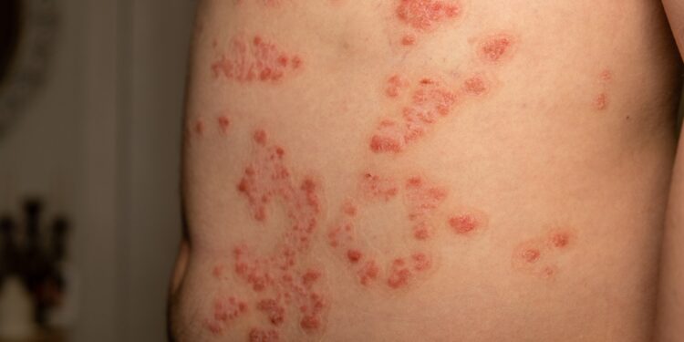 Pempigija foliacija: simptomai, priežastys ir gydymas