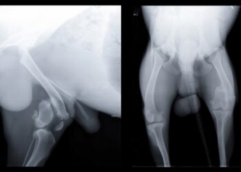 Klubo displazija: simptomai, priežastys ir gydymas