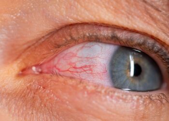 Akių nuovargis: simptomai, priežastys ir gydymas