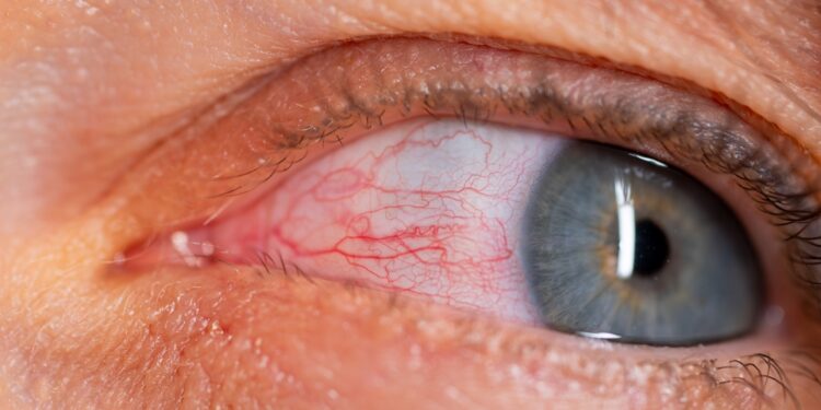 Akių nuovargis: simptomai, priežastys ir gydymas