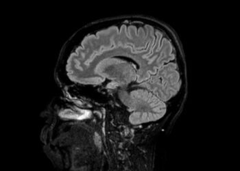 Pineoblastoma: priežastys, simptomai, gydymas ir prognozė