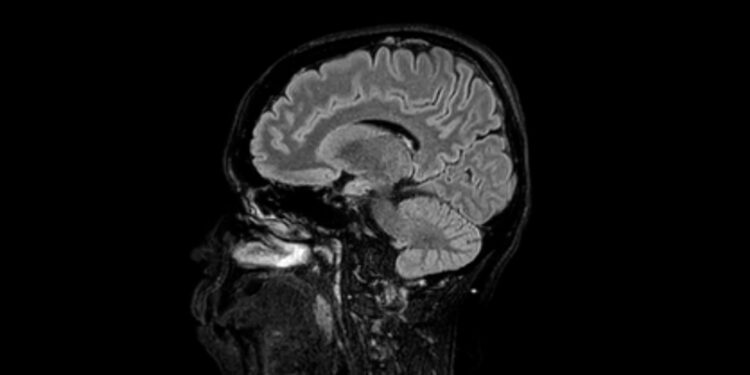 Pineoblastoma: priežastys, simptomai, gydymas ir prognozė