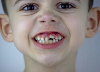 Lesch-Nyhan sindromas: priežastys, simptomai ir gydymas