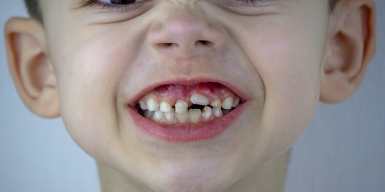 Lesch-Nyhan sindromas: priežastys, simptomai ir gydymas