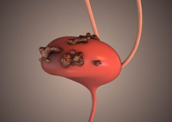 Hemolizinė ureminė (HUS) sindromas: simptomai ir gydymas